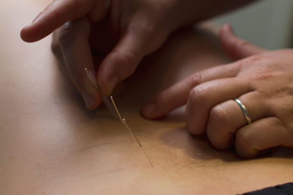 Dry Needling at Physionorth