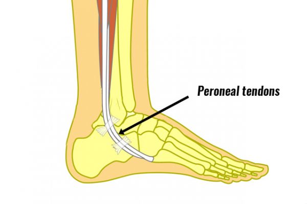 The Peroneals - Peroneus Longus Pain Running