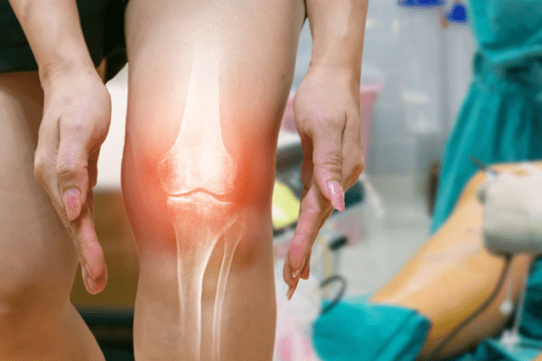 Physiotherapy for Osteoarthritis